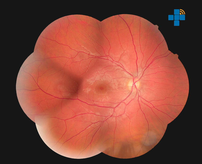 Retine Medicale Ophta Loiret